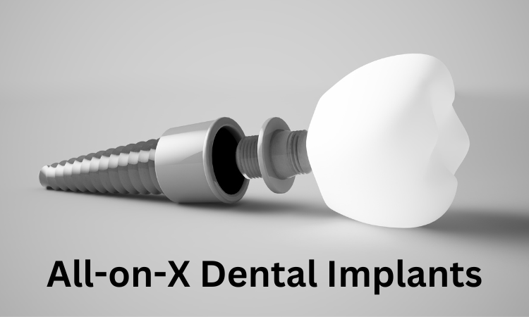 7 Pros and Cons of All-on-X Dental Implants