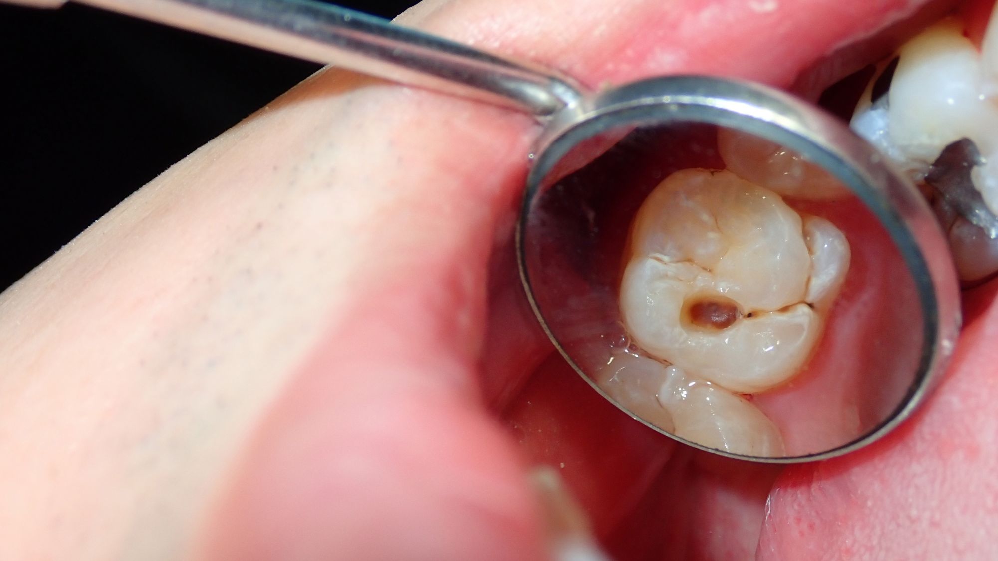 Cavity & Tooth Decay: Symptoms, Causes, Risks and Treatment