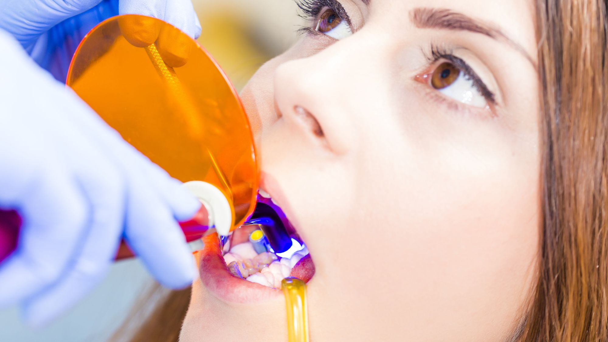 A Guide to Dental Bonding