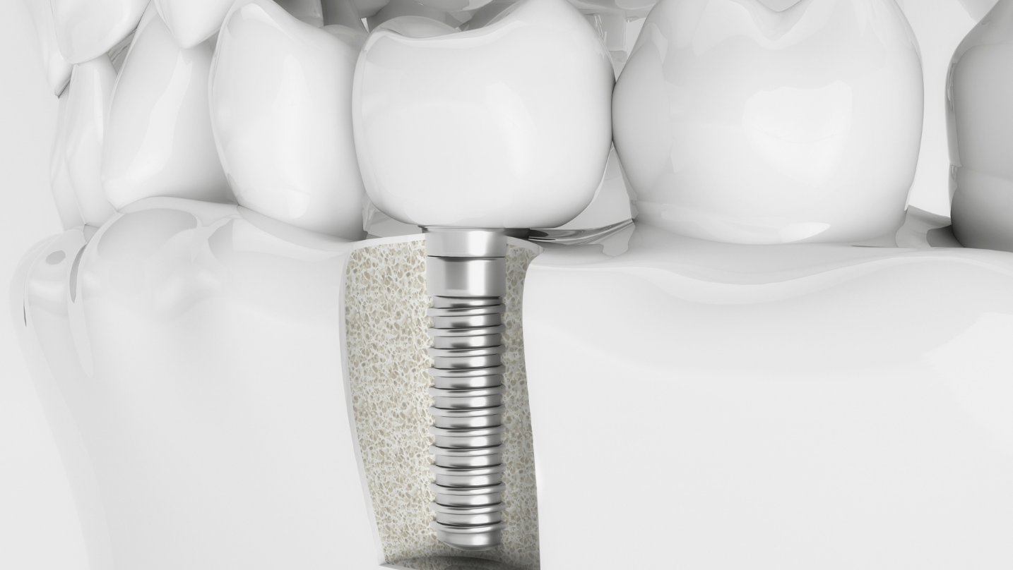 All On X Dental Implants: Procedure, Advantages & Maintenance