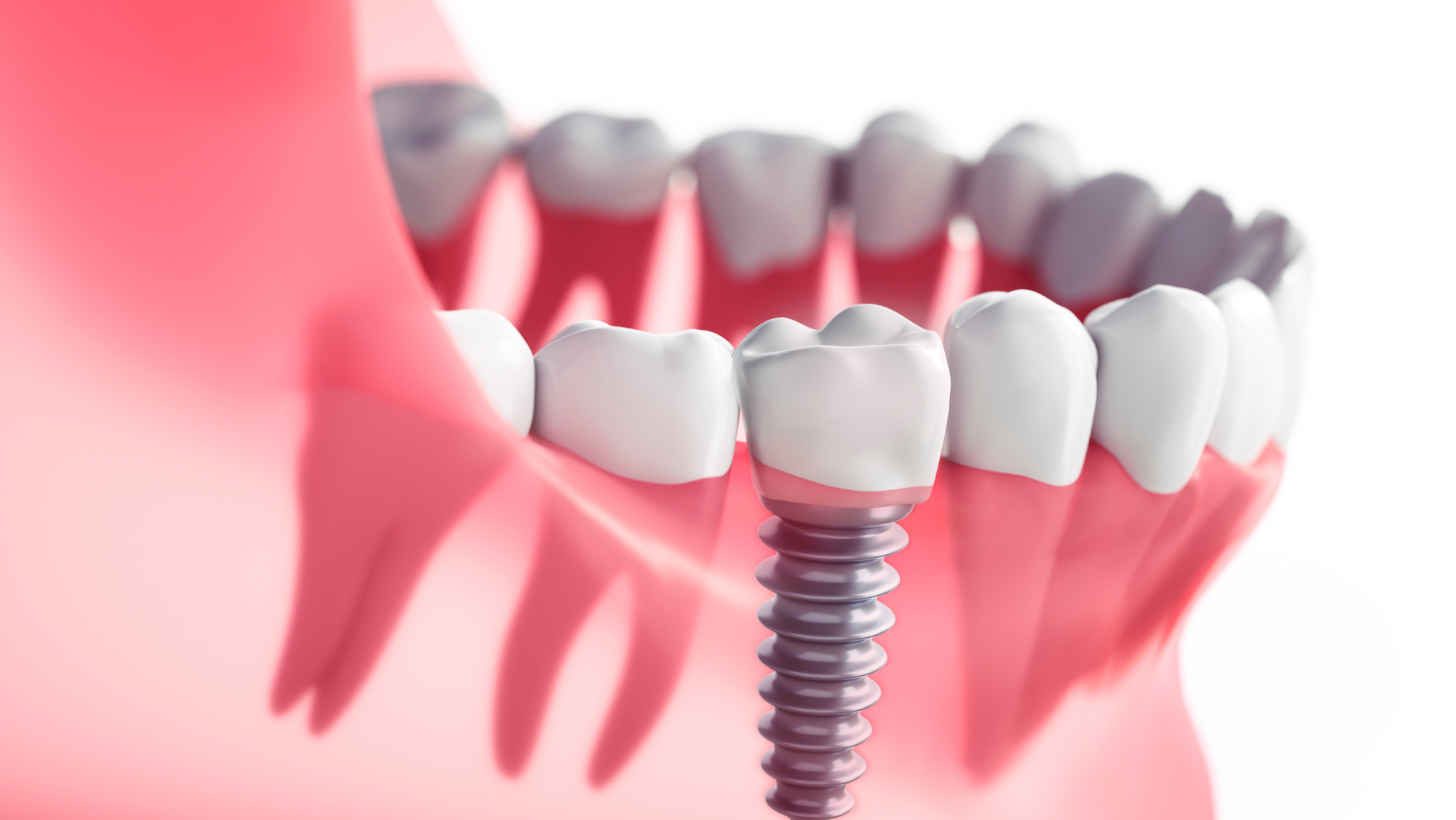 Dental Implants Surgery: Benefits and Types