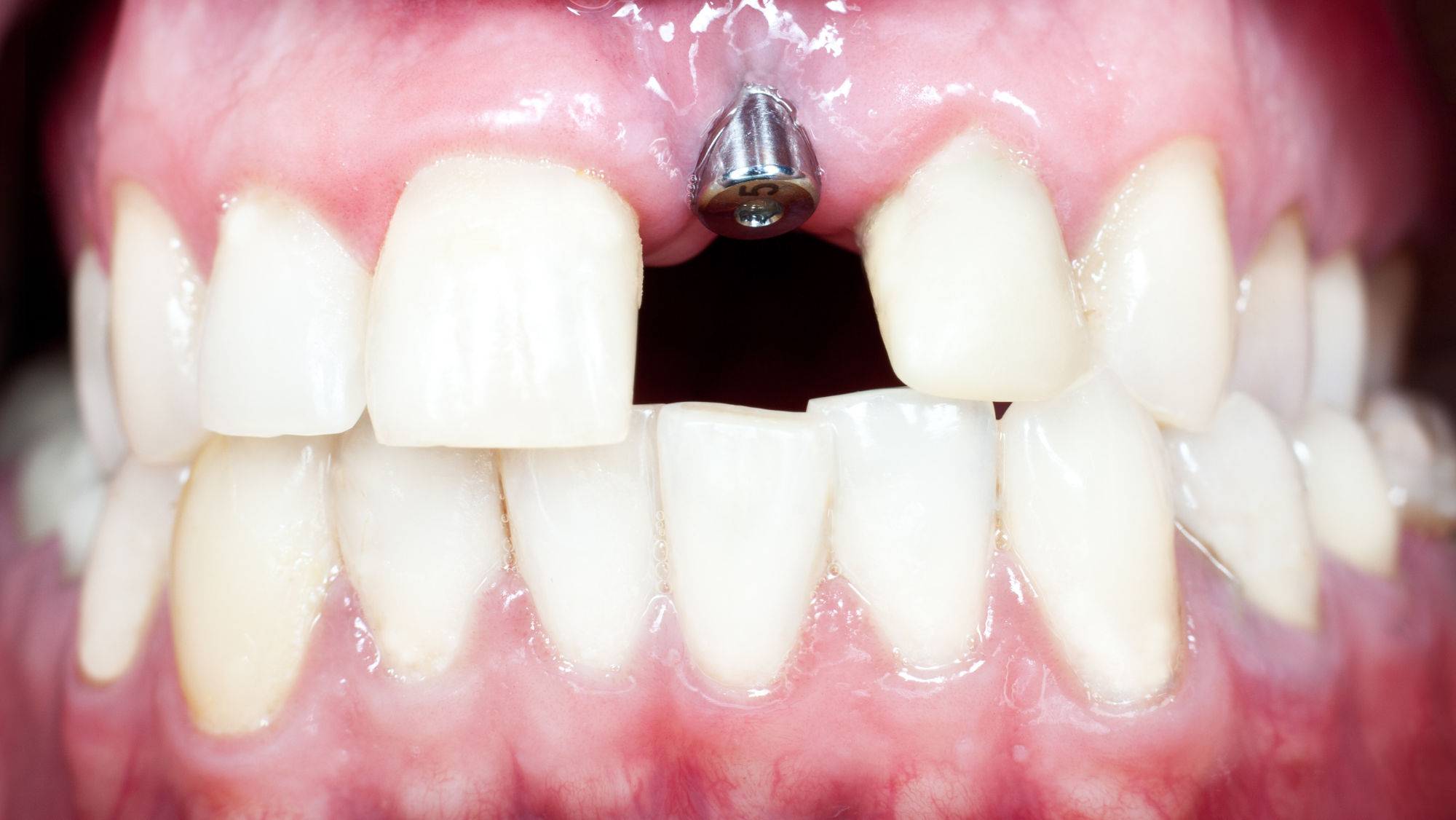 Mini Dental Implants- Procedure and Recovery