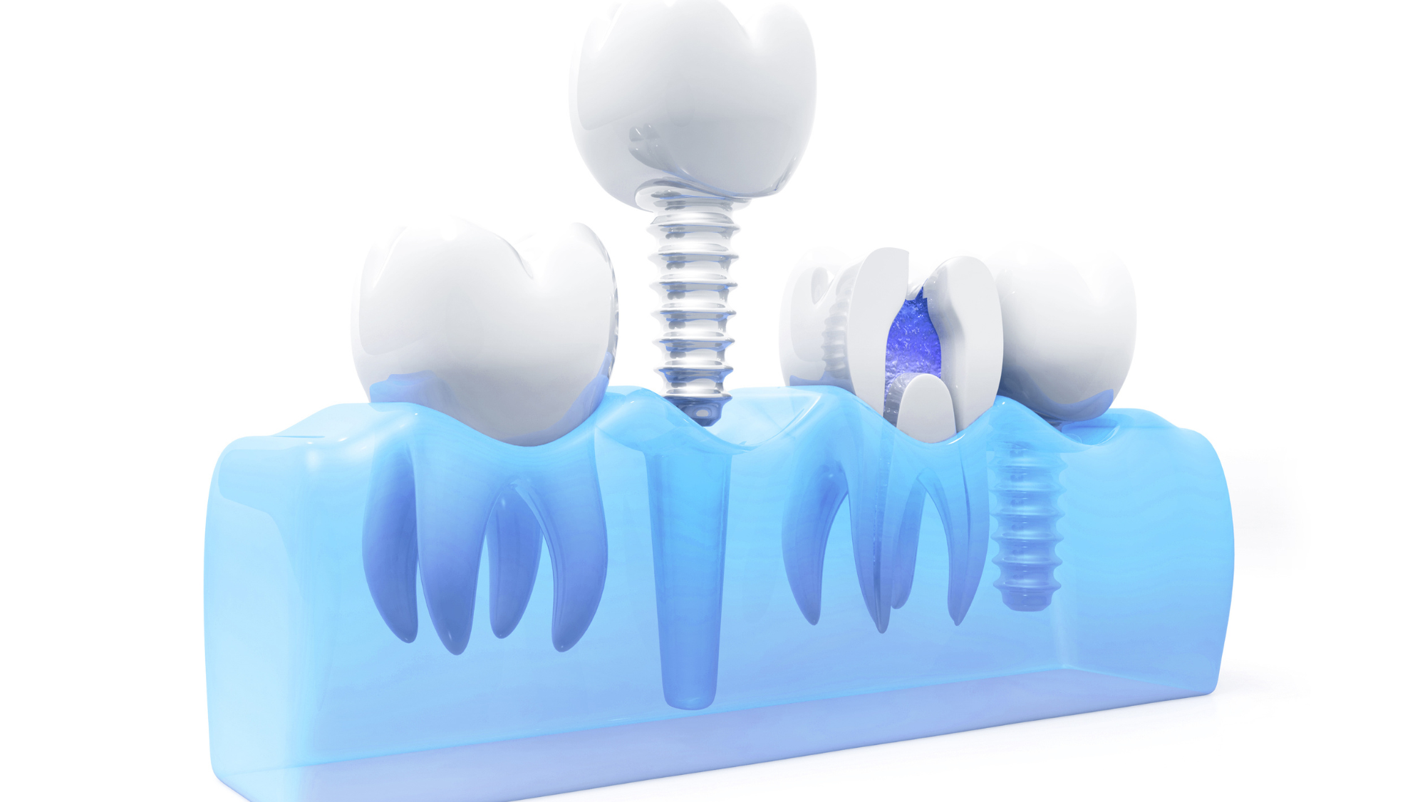 Dental Implants Surgery: Procedure and Recovery