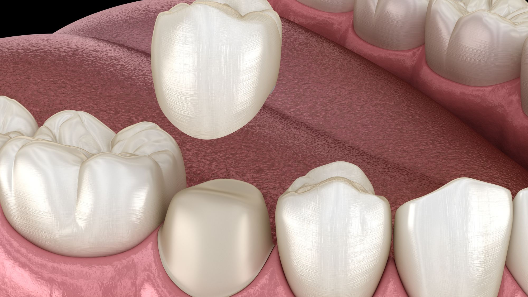 Everything You Need to Know About Dental Crowns
