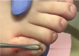 know About Ingrown Toenail Surgery
