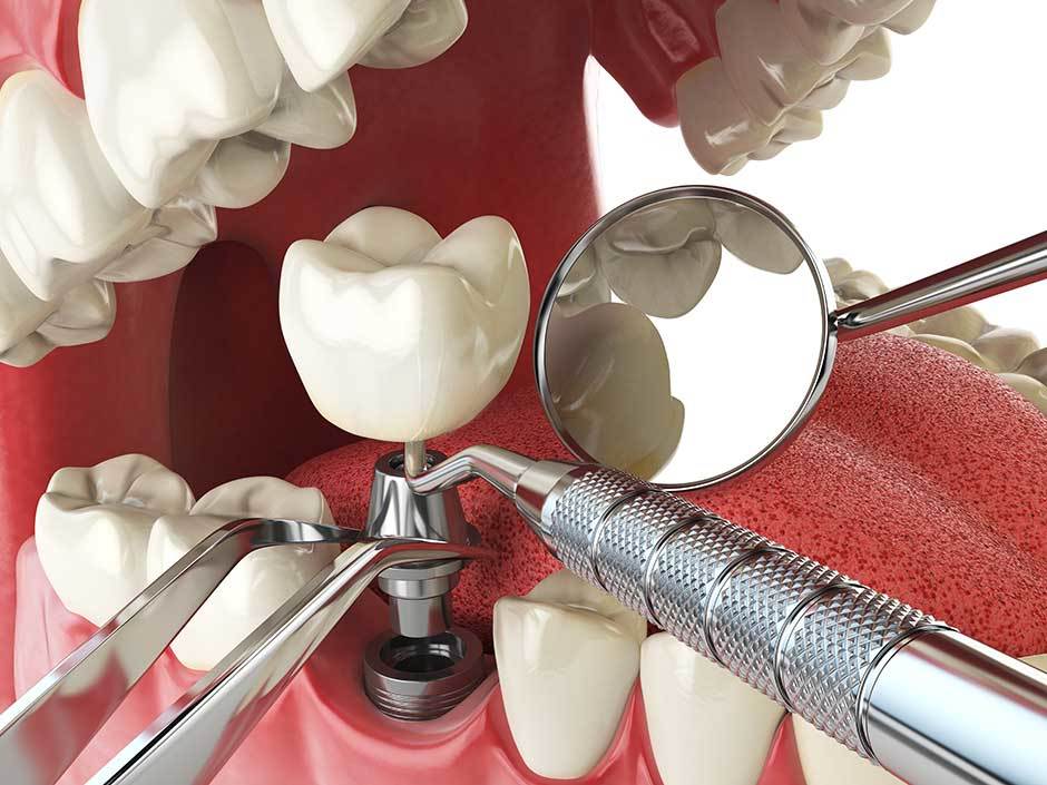 Why Should You Consult With a Cosmetic Dentist? 