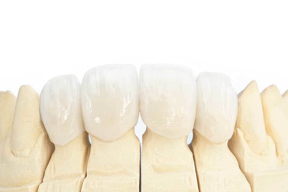 What Should You Know About Dental Implants? 