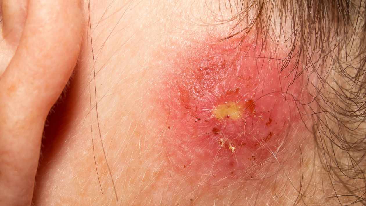 Staph infection on skin