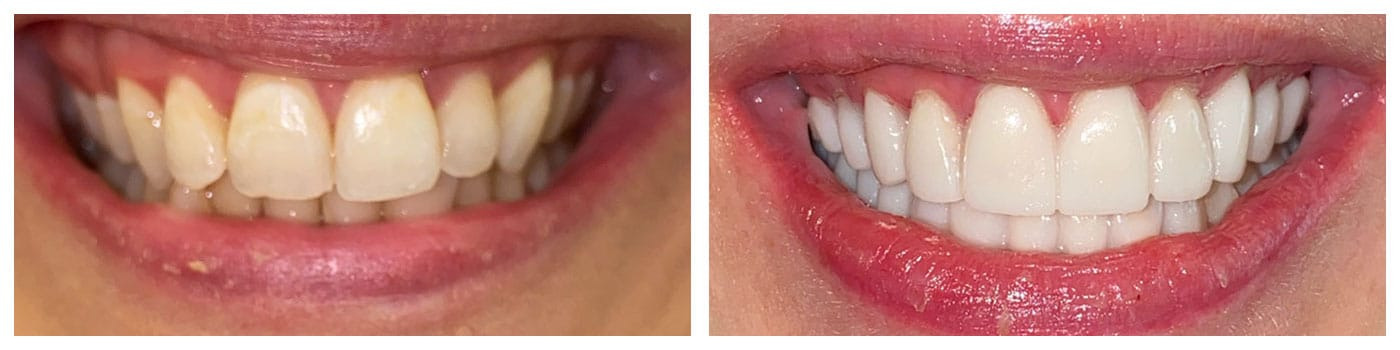WHAT IS THE BEST TOOTH REPLACEMENT SOLUTION FOR TOOTH LOSS DUE TO INJURY?