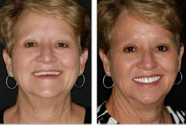 DO I NEED TO REPLACE A TOOTH THAT CAN'T BE SEEN IN MY SMILE?