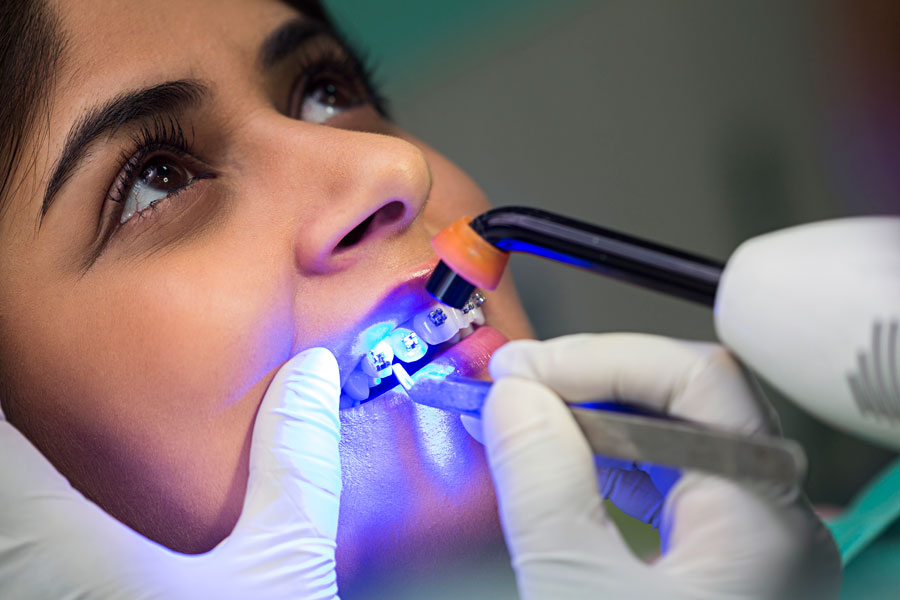 MYTHS AND FACTS ABOUT TEETH BRACES | ORTHODONTIST IN GURGAON
