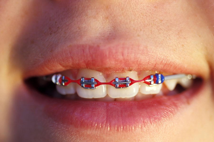 Everything you need to know about Braces | Braces And Aligners - The Dental Home