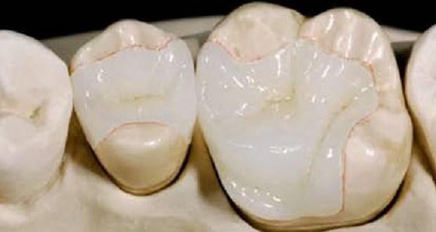 What Is Dental Filling?