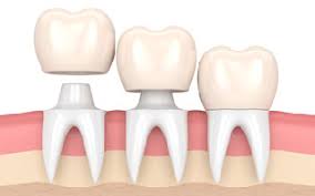 Everything you need to know about DENTAL CROWNS | Dentist in Gurgaon - The Dental Home