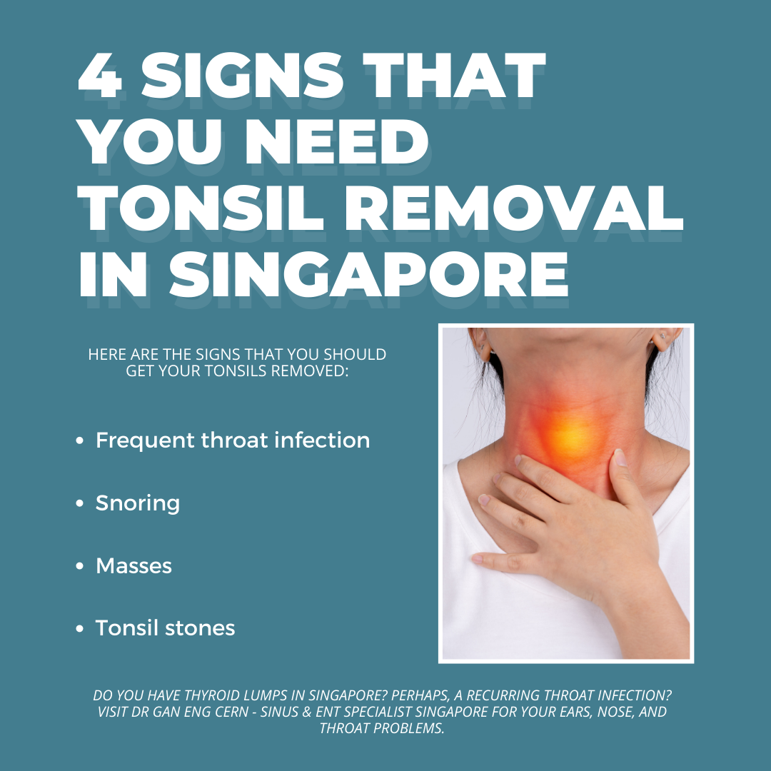 4 Signs That You Need Tonsil Removal In Singapore
