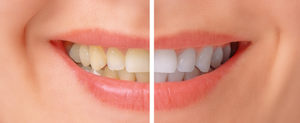 Discolored Teeth: Calgary Dentist Explains Causes and Solutions
