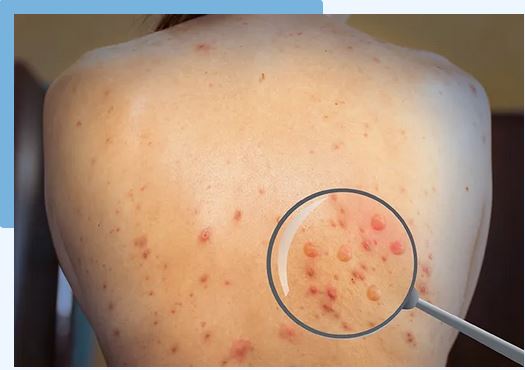 Get Same Day Monkeypox Testing in Chicago