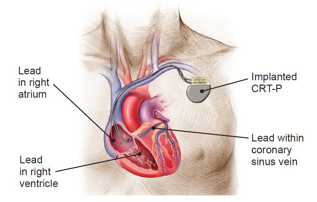 Cardiac Resynchronization Therapy Systems Market: Revolutionizing Heart Failure Care Globally