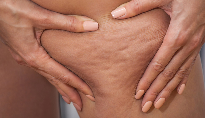 Cellulite Treatment Market: Revolutionizing Aesthetic Care Worldwide