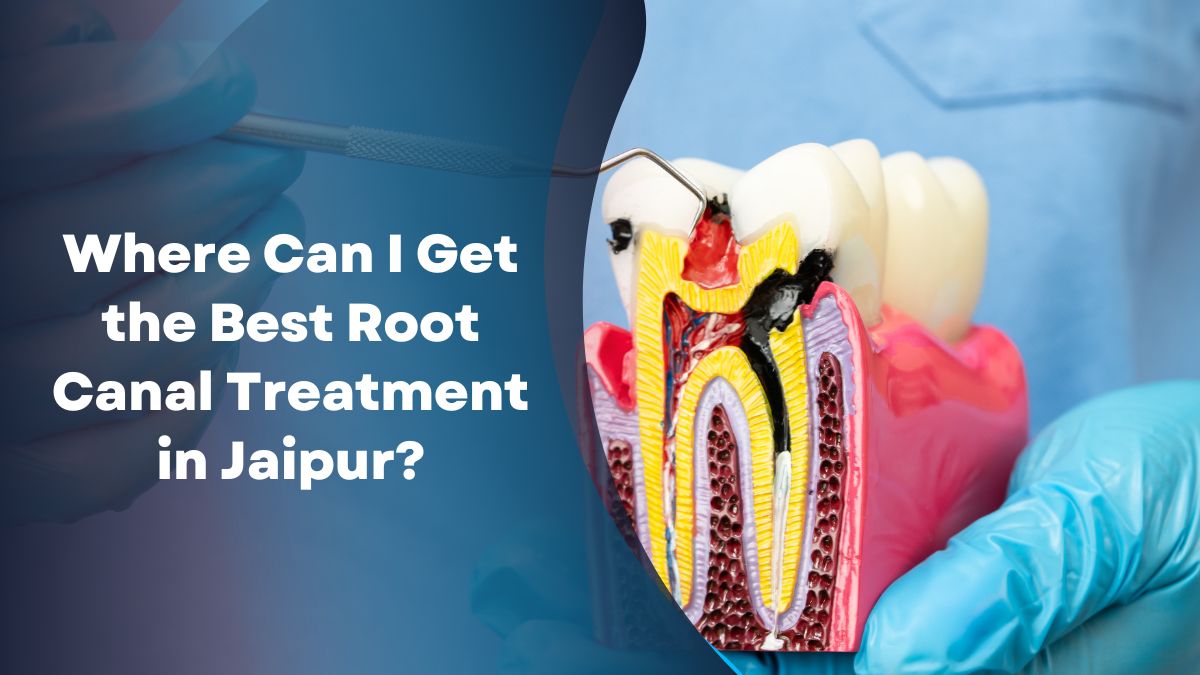 Where Can I Get the Best Root Canal Treatment in Jaipur?
