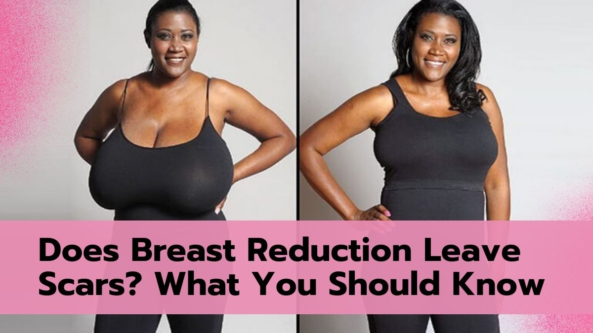 Does Breast Reduction Leave Scars? What You Should Know