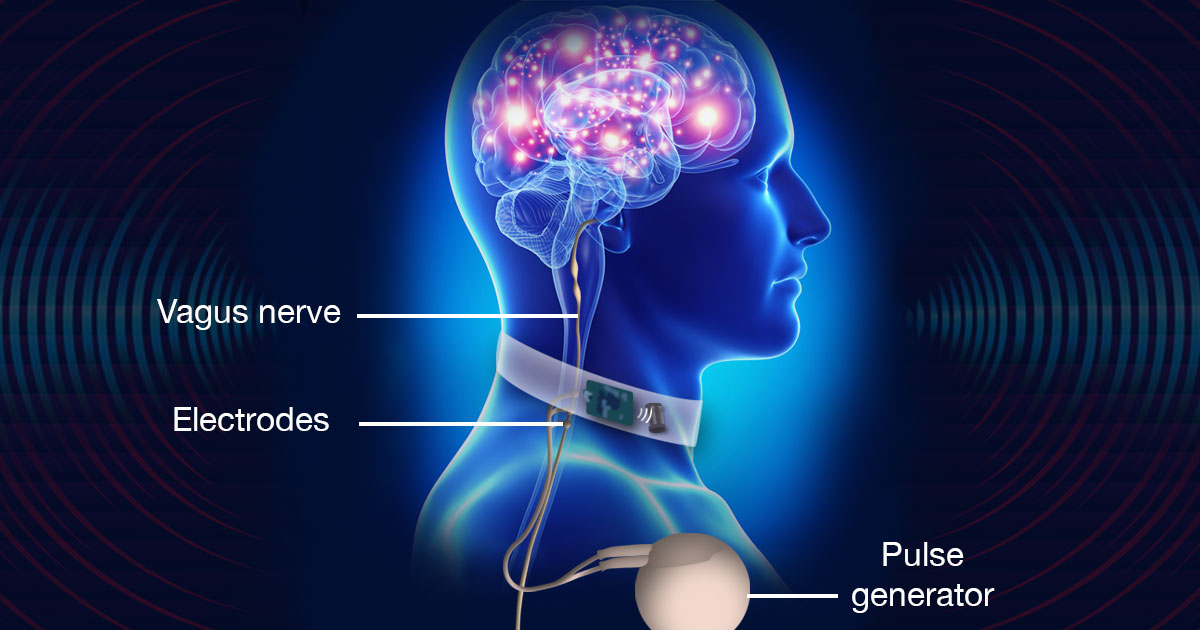 Global Vagus Nerve Stimulators Market Is Estimated To Witness High Growth Owing To Increasing Demand for Non-Invasive Treatment Options