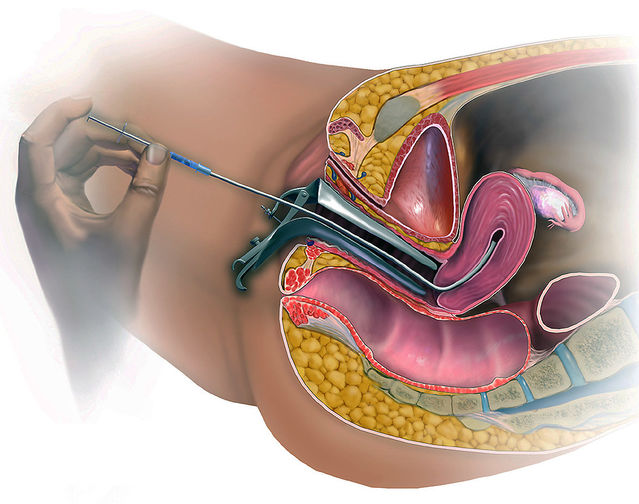 Artificial Insemination Market to Reach USD 4.47 Billion by 2023, Growing at a CAGR of 6.45% from 2023 to 2028