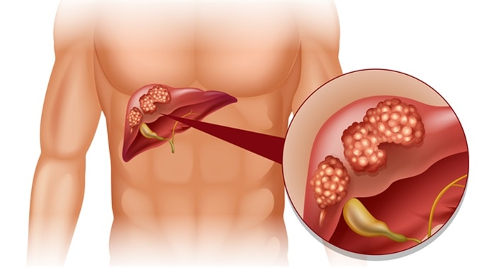 What All Yo need To Know About Uses of Bile Duct Cancer