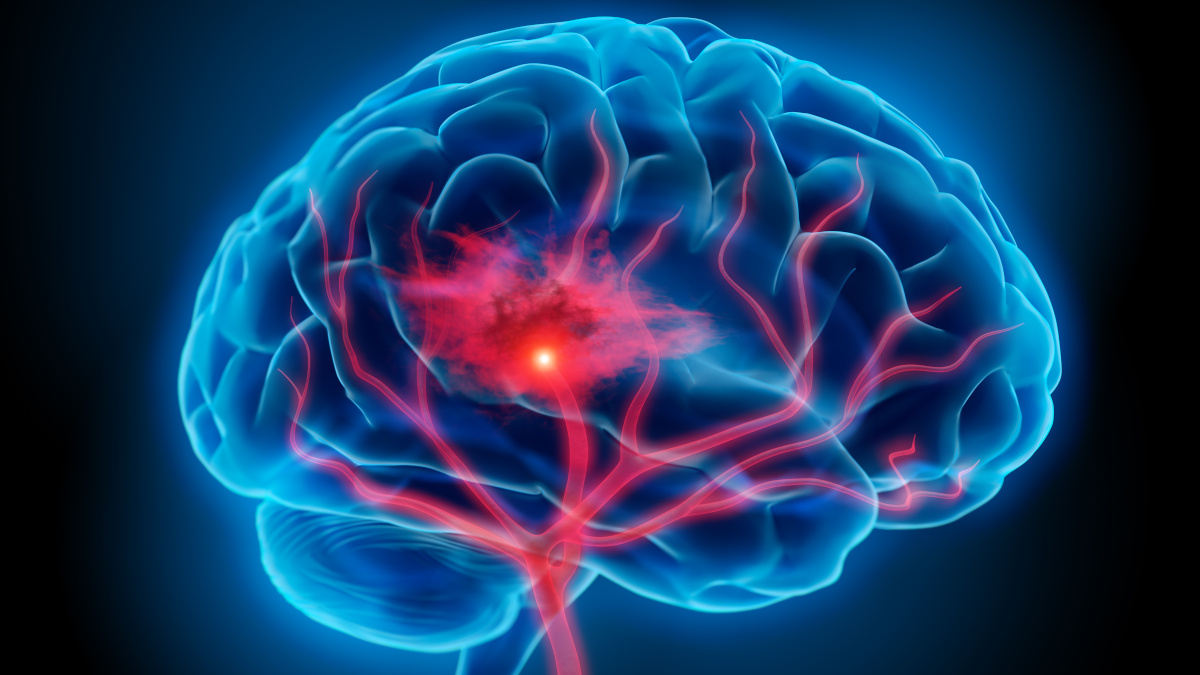 Brain Hemorrhage Market Top Companies, Trends & Growth Factors And Trend Forecast To 2025