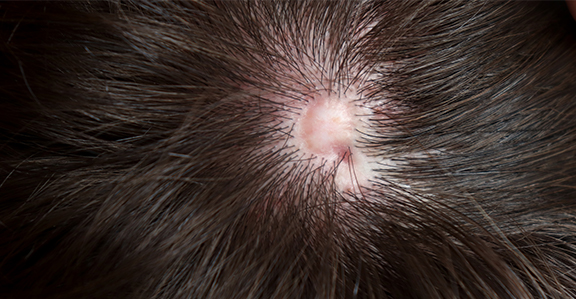 SCARRING ALOPECIA TREATMENT IN PUNE