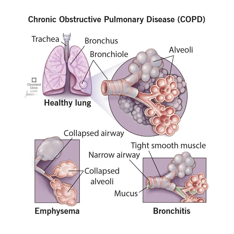 What is Chronic obstructive pulmonary disease (COPD) ?