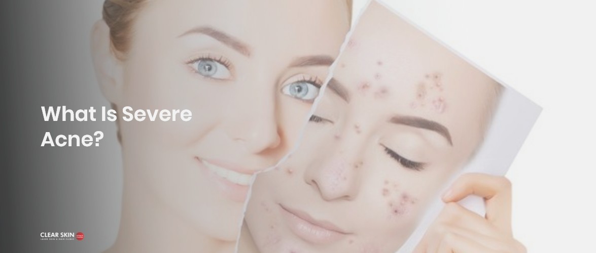  What Is Severe Acne? How can it be treated? | Clear Skin | Pune 