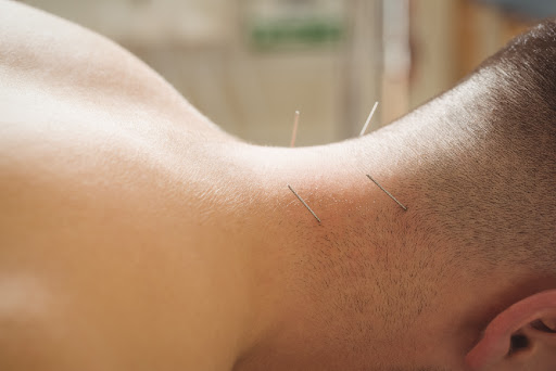 Acupuncture - The Oldest Holistic Healing Technique for Pain 