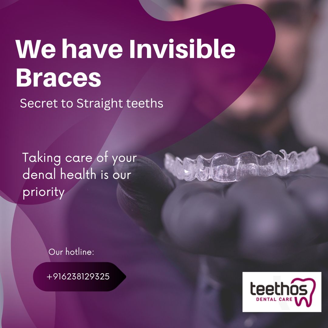 Why Clear Aligner Cost in Kerala Is Higher Than You expected?