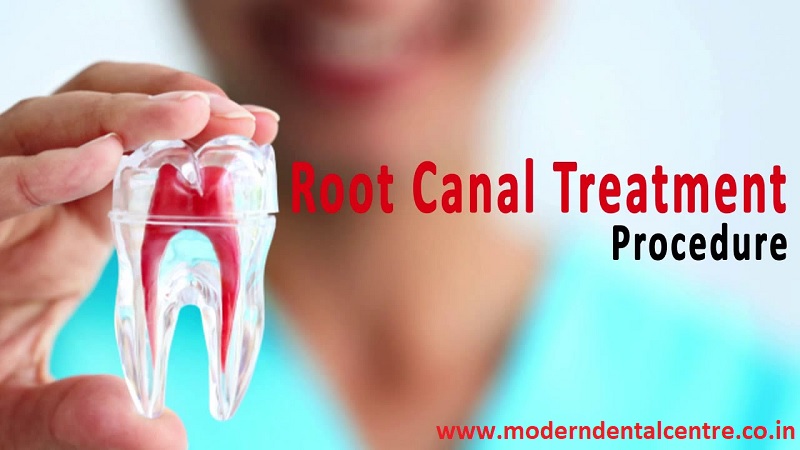 What is Root Canal Treatment Procedure? Step By Step Guide on Procedures to Follow