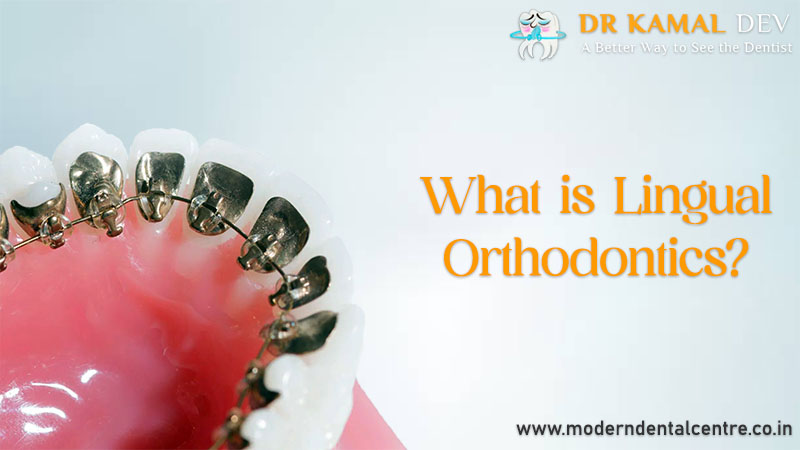 Do you want a perfect smile? Bet on Lingual Orthodontics