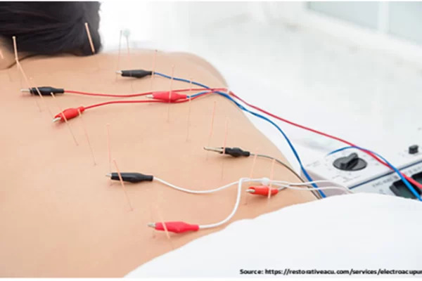 Benefits of electro- acupuncture