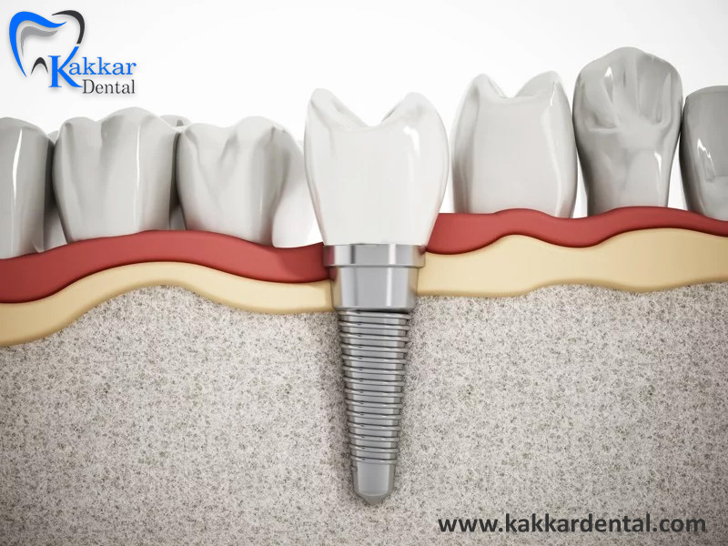 The dental implant: what should you know?