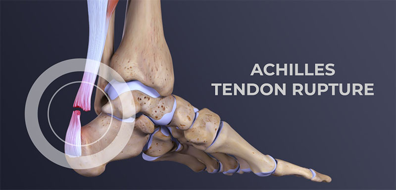 Achilles tendon rupture - treatment, surgery