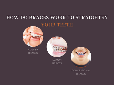 How Do Braces Work to Straighten Your Teeth 