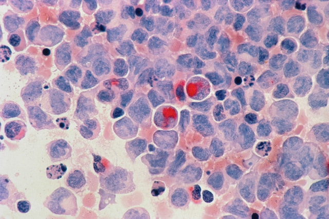 Analyzing the ways to ease up stress and anxiety during cancer treatment