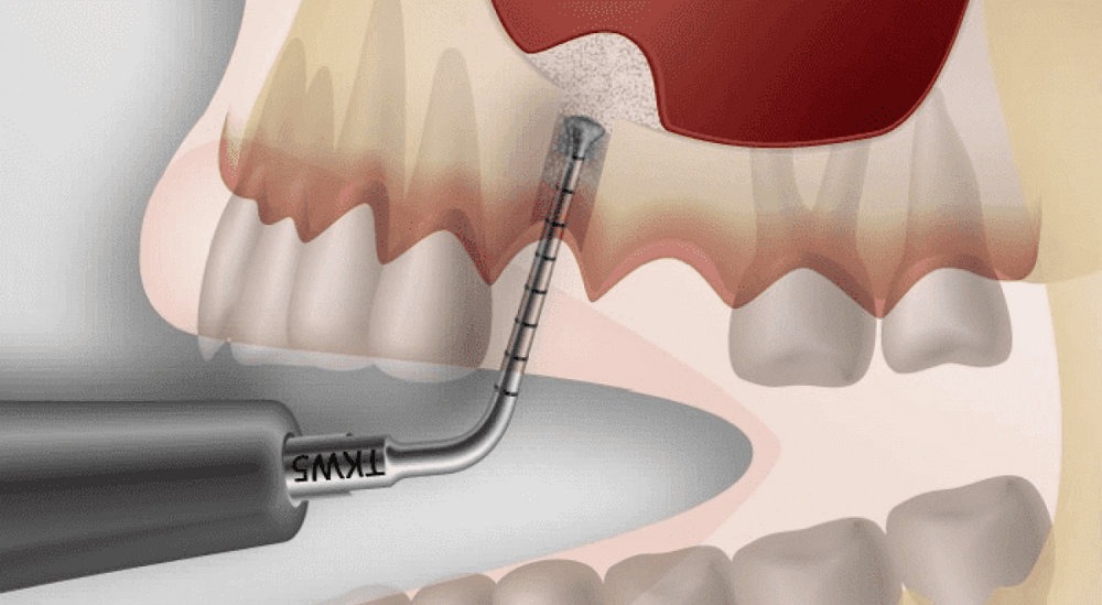 The key benefits of Dental Implants
