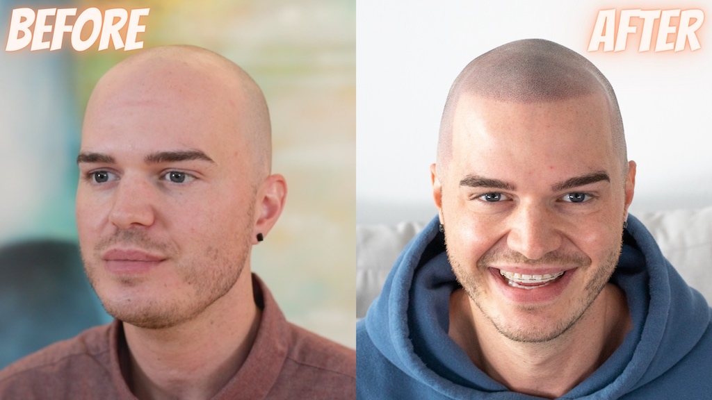 Scalp  Micropigmentation Overview & Locations