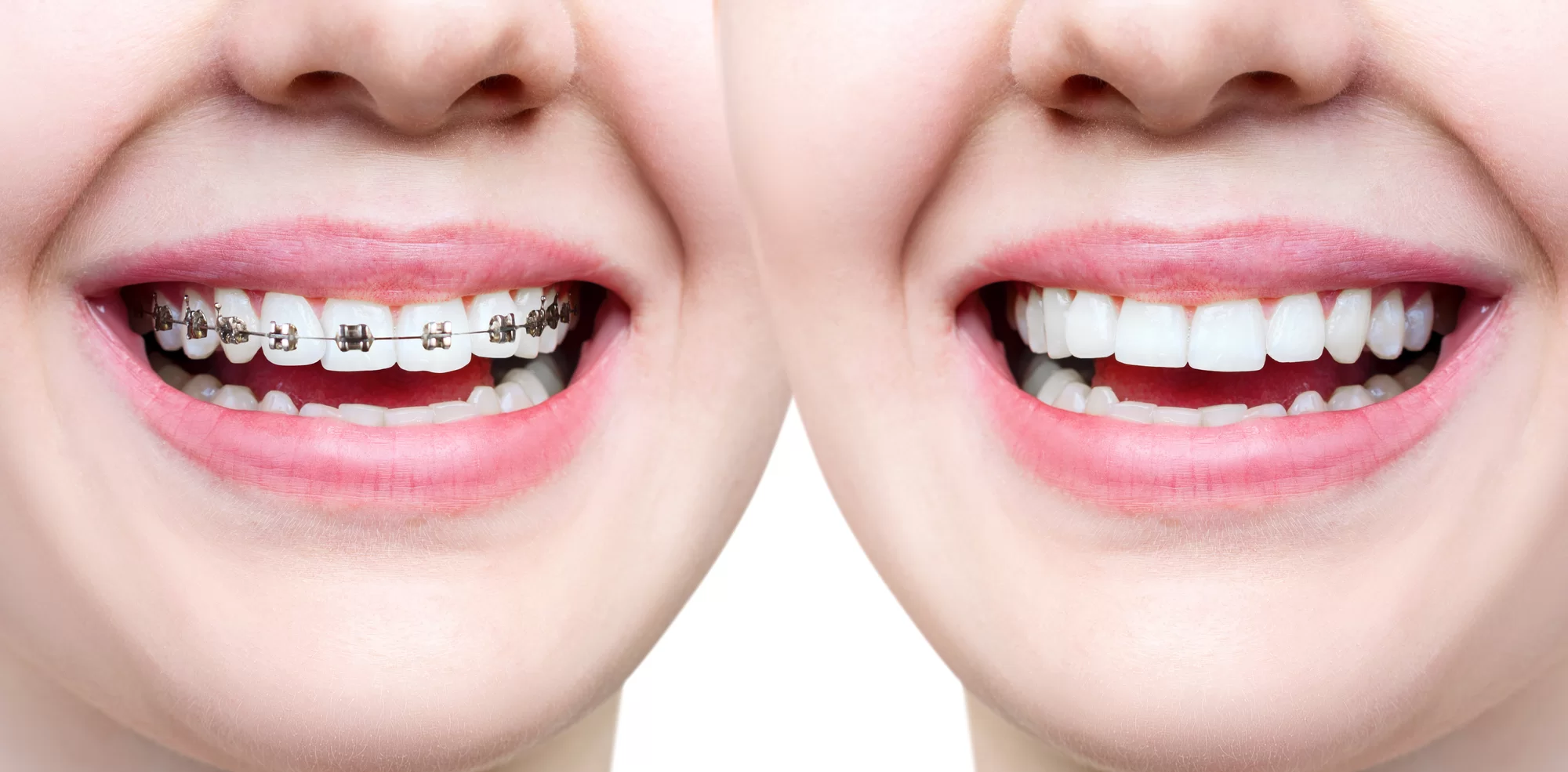 Restore your smile using Invisalign, here it is how?