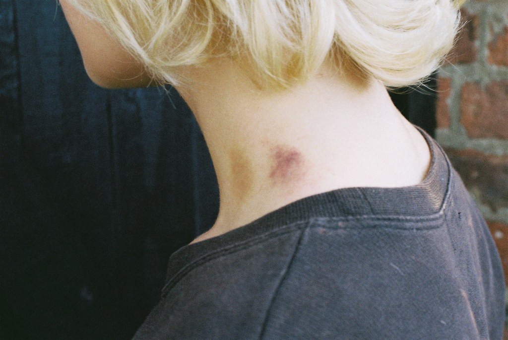 Separating Fact from Fiction on Whether Can Hickey Cause Cancer 