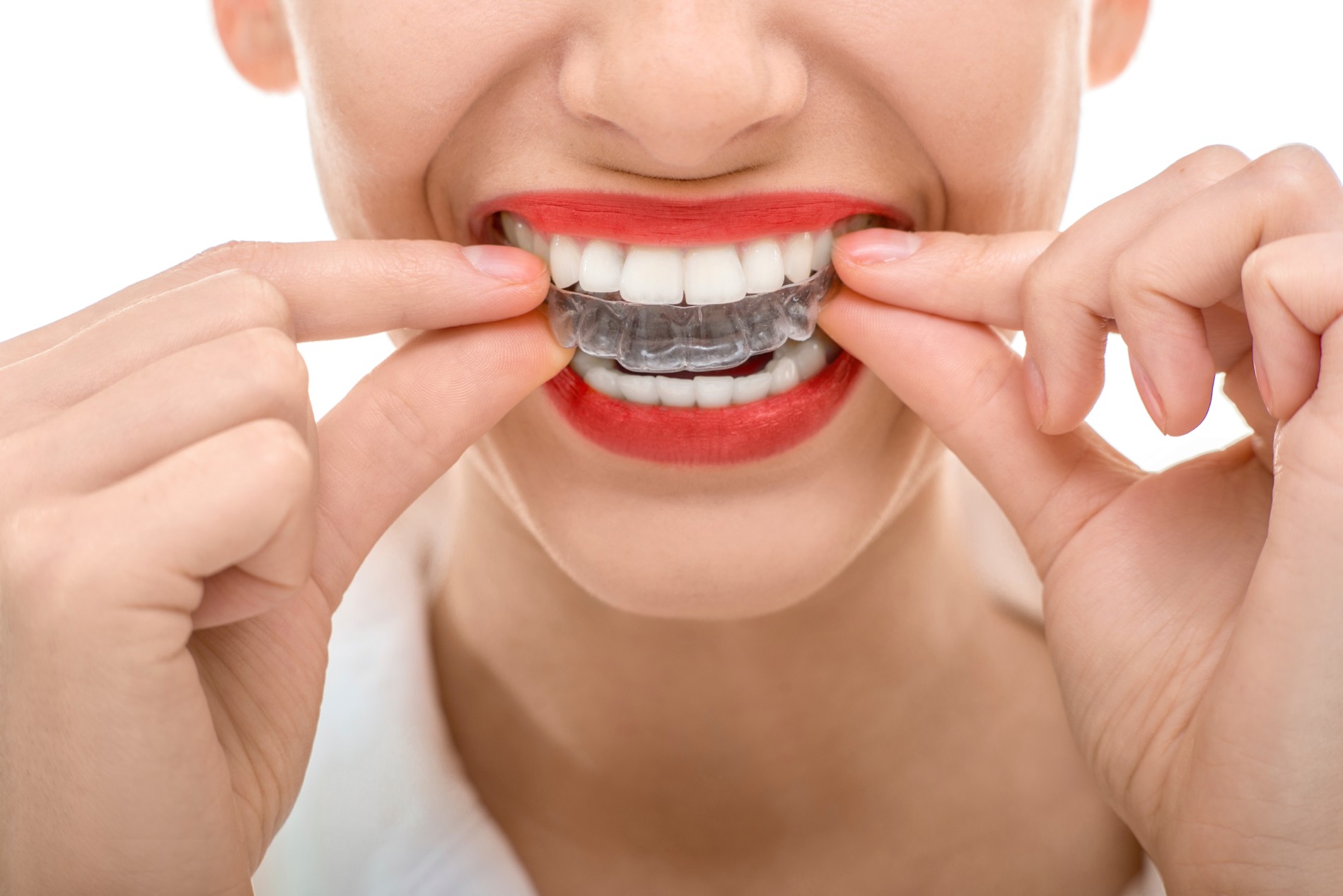 The Benefits of Invisalign