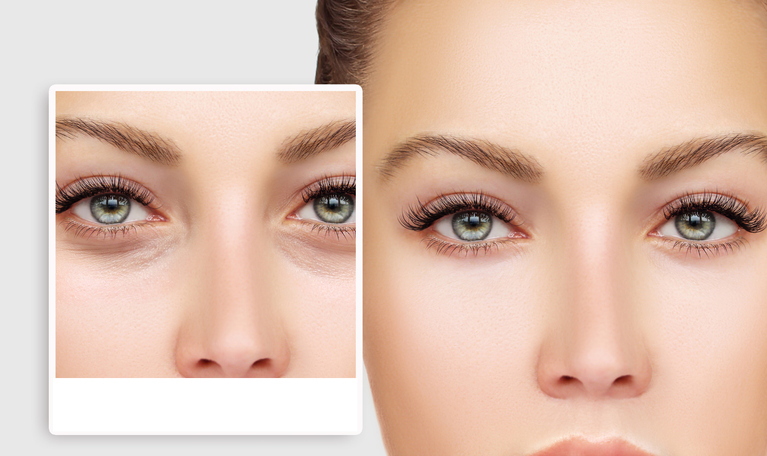Learn About the Different Types of Dark Circle Laser Treatments and How They Can Help You!