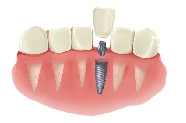How to Examine the Cost of Dental Implants? 