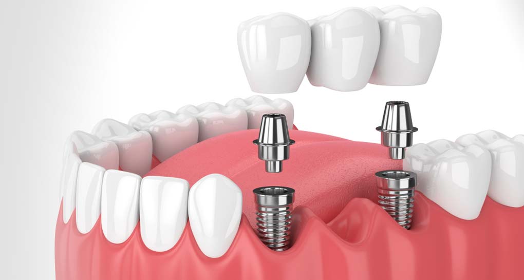 Benefits of Dental Implant