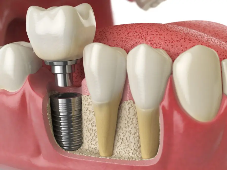 Types Of Dental Implants In Saskatoon